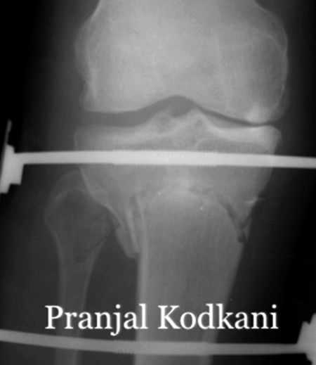 x-ray-of-dome-osteotomy